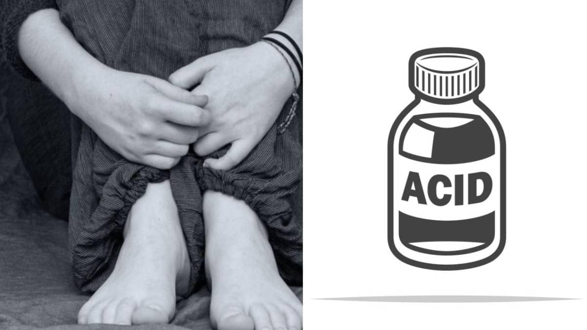 Delhi Student Attacked With Acid Outside College By Stalker In Ashok Vihar, Police Launch Manhunt