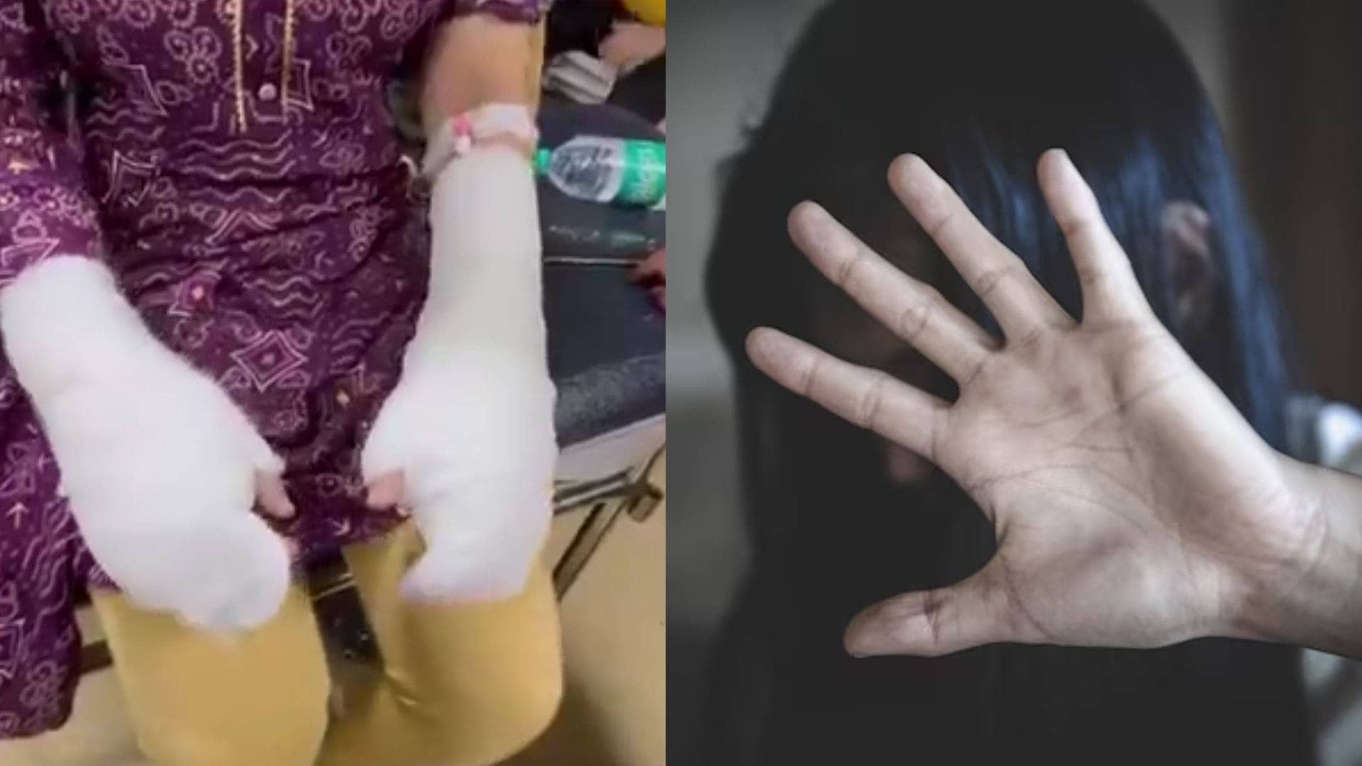 Delhi Acid Attack: Shocking Twist Emerges As Police Probe Reveals Victim’s Father May Have Orchestrated Assault To Frame Accused Stalker